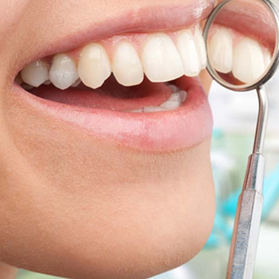 【图】24岁龅牙怎么矫正呢 6种方法让你拥有整齐的牙齿