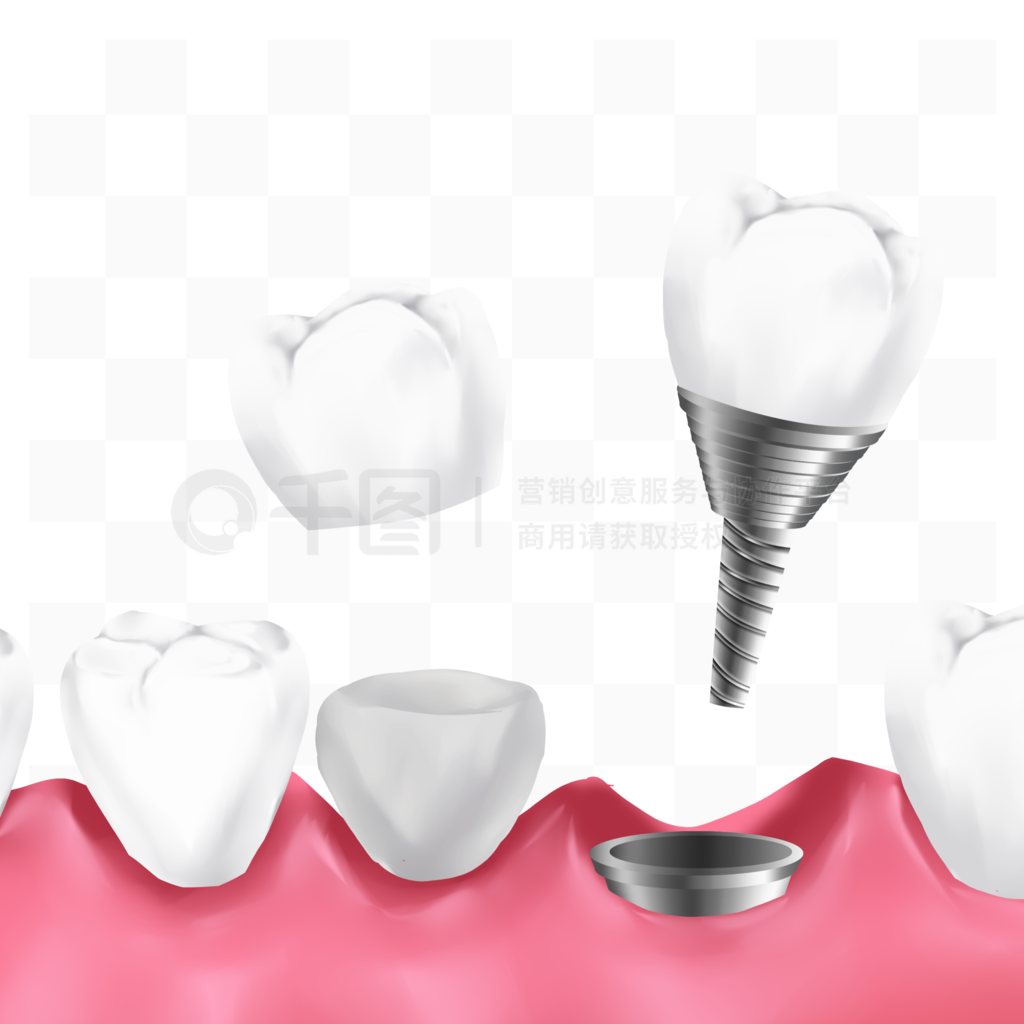3d类牙产品元素种植牙种牙上牙套美容牙齿模板免费下载_psd格式_3072像素_编号43876057