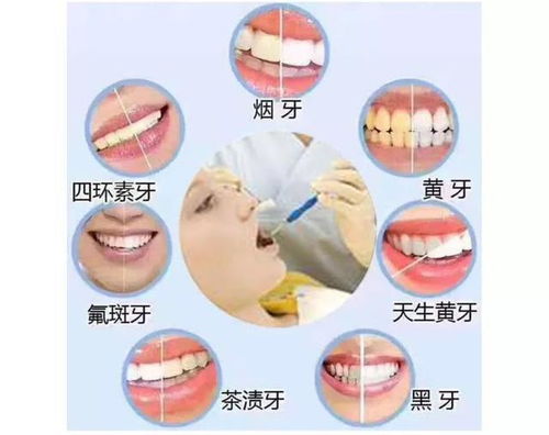 我为什么不用美白牙贴 这些牙齿美白方法能一劳永逸
