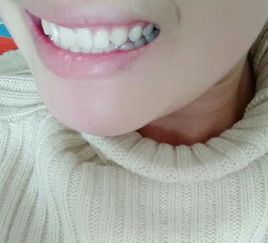 牙齿冷光美白效果怎么样