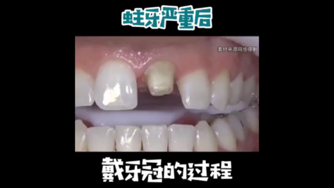 全全瓷牙齿贴面全流程。