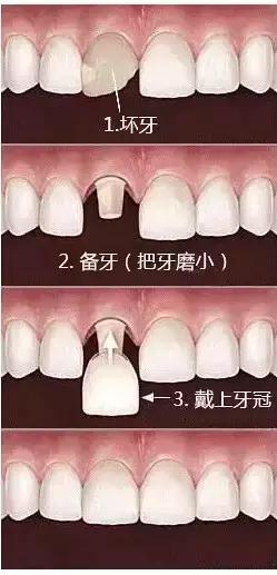 牙齿美容?刘涛亲身经历告诉你牙齿美容的血泪史!