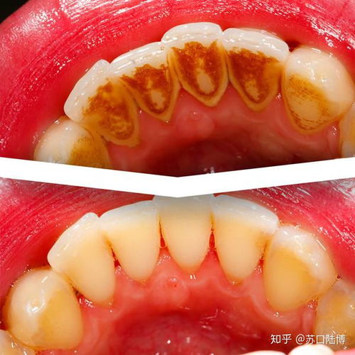 有什么好的可以有效美白牙齿的方法吗