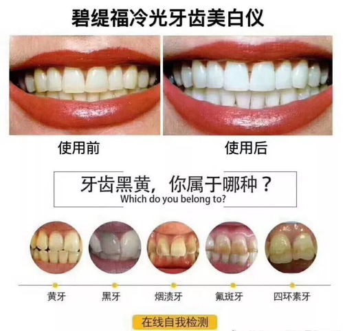 碧缇福冷光牙齿美白仪常问问题解答